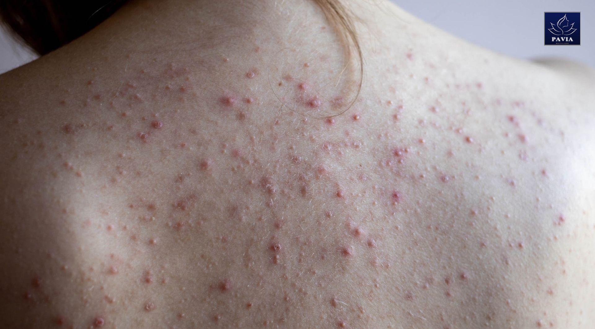 Tổng quan về tình trạng mụn ở lưng