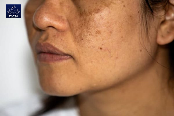 Tác Động Của Nám Da