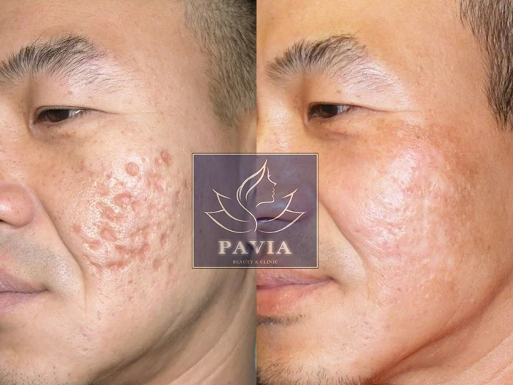 Sẹo lõm có chữa được không? Giải pháp nào hiệu quả nhất?