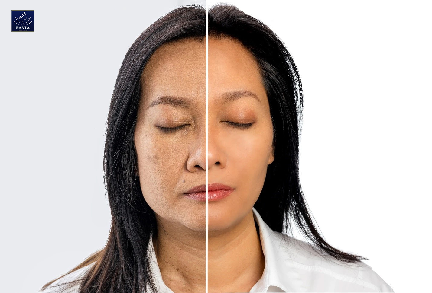 Hiểu Rõ về Sự Chảy Xệ của Da