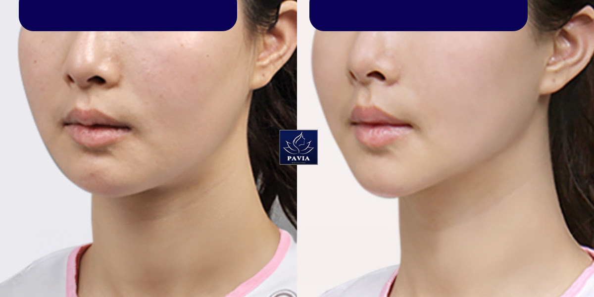 Lợi ích của việc loại bỏ mỡ má